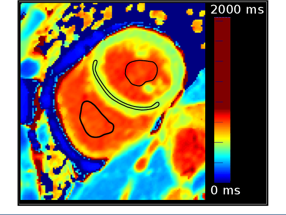 Figure 3 for Automated quantification of myocardial tissue characteristics from native T1 mapping using neural networks with Bayesian inference for uncertainty-based quality-control