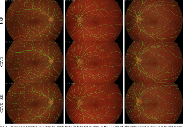 Figure 4 for On the Evaluation and Real-World Usage Scenarios of Deep Vessel Segmentation for Funduscopy