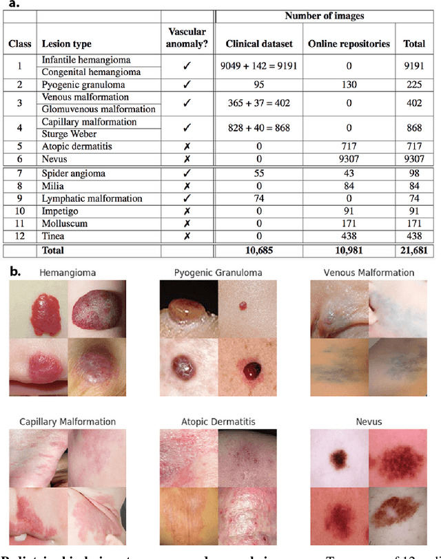 Figure 1 for Identifying Pediatric Vascular Anomalies With Deep Learning