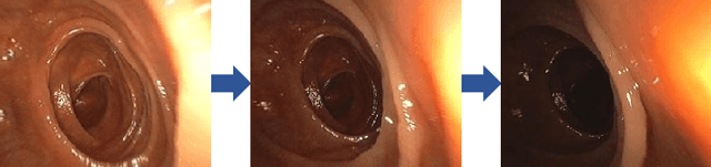 Figure 1 for Lighting Enhancement Aids Reconstruction of Colonoscopic Surfaces