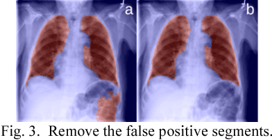 Figure 3 for SDFN: Segmentation-based Deep Fusion Network for Thoracic Disease Classification in Chest X-ray Images