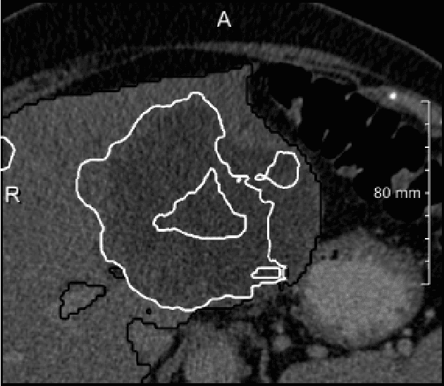 Figure 3 for Neural Network-Based Automatic Liver Tumor Segmentation With Random Forest-Based Candidate Filtering