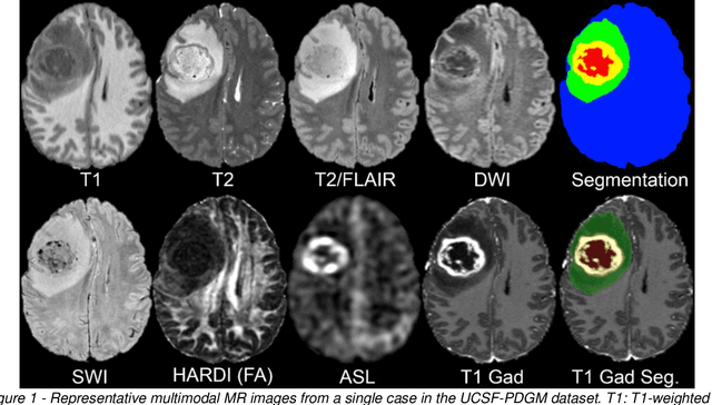 Figure 2 for The University of California San Francisco Preoperative Diffuse Glioma MRI Dataset