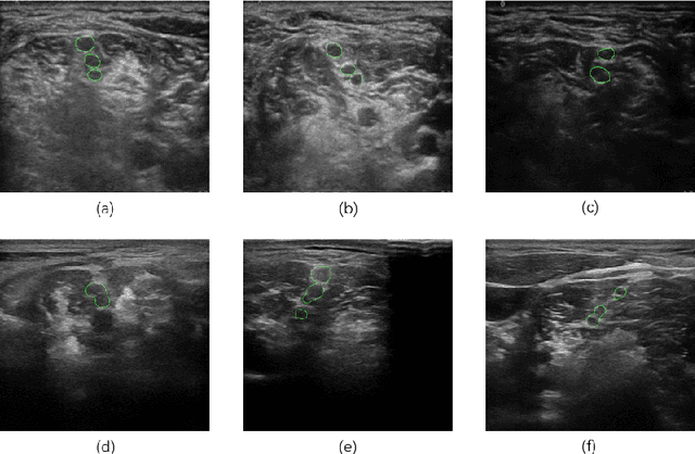 Figure 2 for Brachial Plexus Nerve Trunk Segmentation Using Deep Learning: A Comparative Study with Doctors' Manual Segmentation
