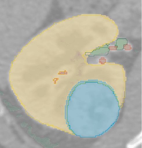 Figure 3 for Ensembled Autoencoder Regularization for Multi-Structure Segmentation for Kidney Cancer Treatment