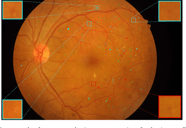 Figure 4 for Multi-scale Microaneurysms Segmentation Using Embedding Triplet Loss