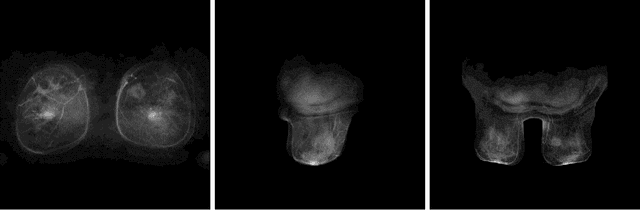 Figure 2 for Deep learning analysis of breast MRIs for prediction of occult invasive disease in ductal carcinoma in situ