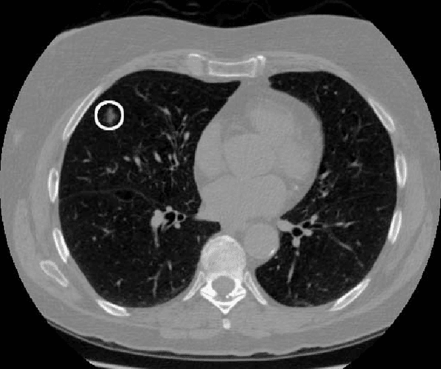 Figure 3 for Deep Learning for Lung Cancer Detection: Tackling the Kaggle Data Science Bowl 2017 Challenge