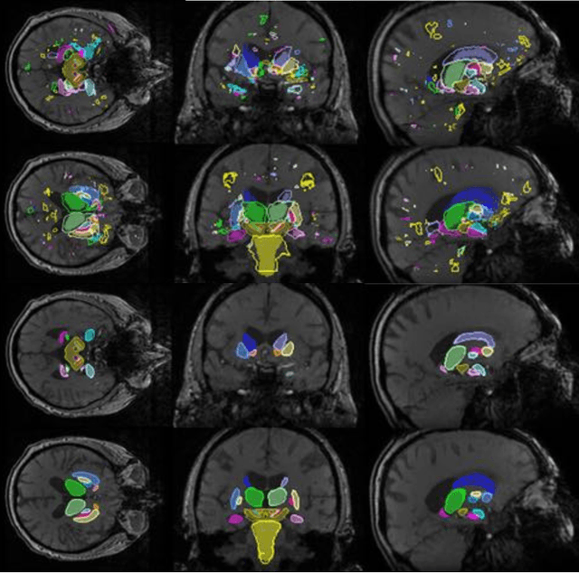 Figure 4 for Hough-CNN: Deep Learning for Segmentation of Deep Brain Regions in MRI and Ultrasound