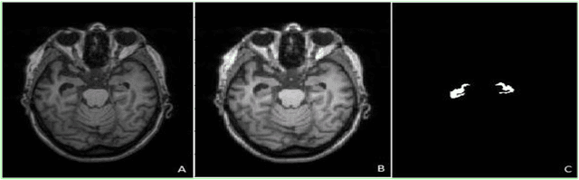 Figure 3 for Hippocampus segmentation in magnetic resonance images of Alzheimer's patients using Deep machine learning