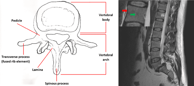 Figure 3 for Cube-Cut: Vertebral Body Segmentation in MRI-Data through Cubic-Shaped Divergences