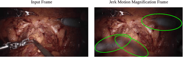 Figure 1 for Surgical Video Motion Magnification with Suppression of Instrument Artefacts