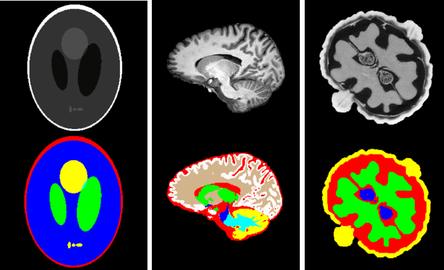 Figure 1 for Oversampling errors in multimodal medical imaging are due to the Gibbs effect