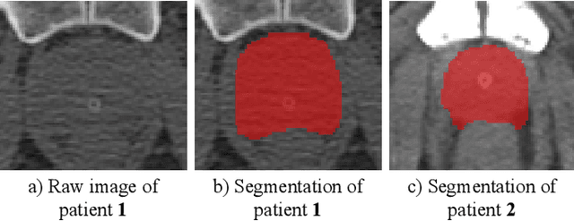 Figure 3 for TripletUNet: Multi-Task U-Net with Online Voxel-Wise Learning for Precise CT Prostate Segmentation