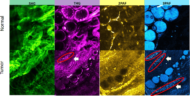Figure 2 for Individualized Multilayer Tensor Learning with An Application in Imaging Analysis