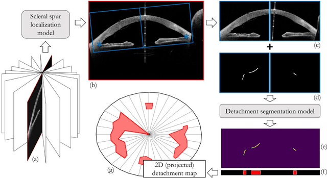 Figure 1 for Quantifying Graft Detachment after Descemet's Membrane Endothelial Keratoplasty with Deep Convolutional Neural Networks