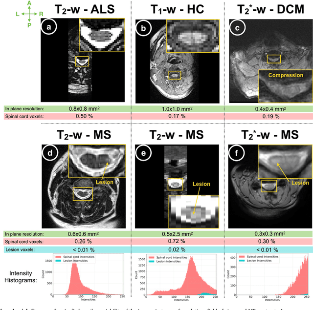 Figure 1 for Automatic segmentation of the spinal cord and intramedullary multiple sclerosis lesions with convolutional neural networks