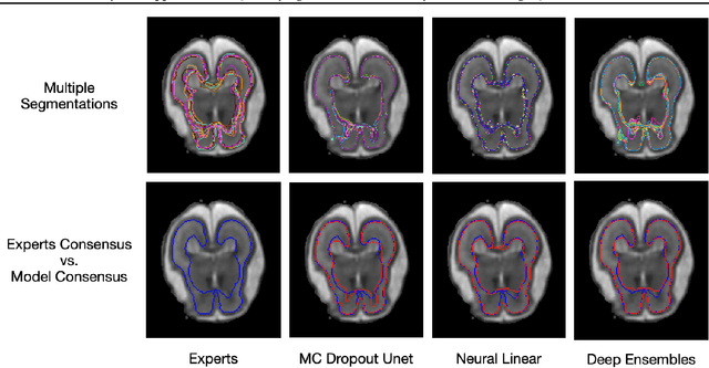 Figure 1 for Bayesian approaches for Quantifying Clinicians' Variability in Medical Image Quantification
