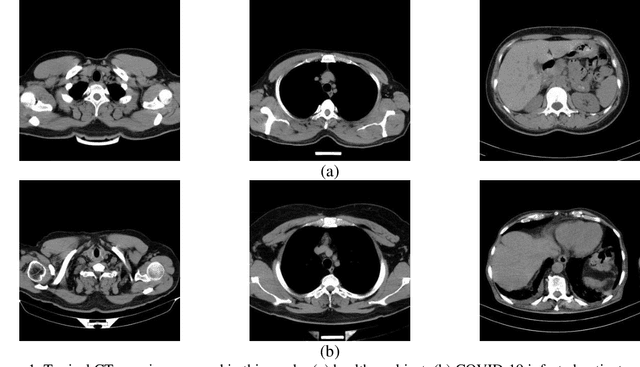 Figure 2 for Uncertainty-Aware Semi-supervised Method using Large Unlabelled and Limited Labeled COVID-19 Data