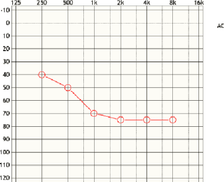 Figure 1 for Interpreting Audiograms with Multi-stage Neural Networks