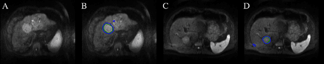 Figure 1 for SurvivalNet: Predicting patient survival from diffusion weighted magnetic resonance images using cascaded fully convolutional and 3D convolutional neural networks