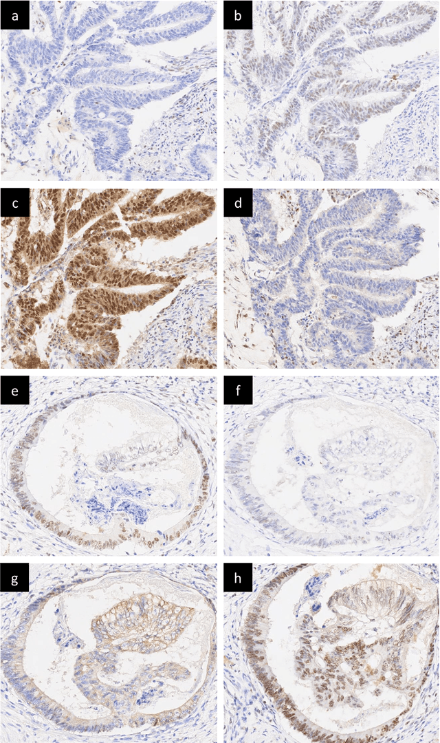 Figure 1 for Deep Learning based Prediction of MSI in Colorectal Cancer via Prediction of the Status of MMR Markers