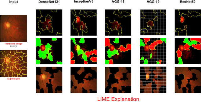 Figure 4 for Explainable AI based Glaucoma Detection using Transfer Learning and LIME