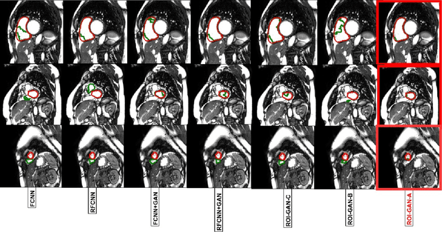 Figure 3 for A Generative Adversarial Model for Right Ventricle Segmentation