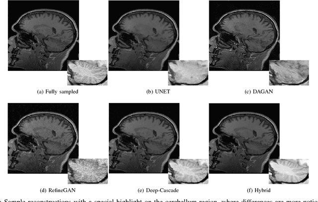 Figure 4 for A Hybrid Frequency-domain/Image-domain Deep Network for Magnetic Resonance Image Reconstruction