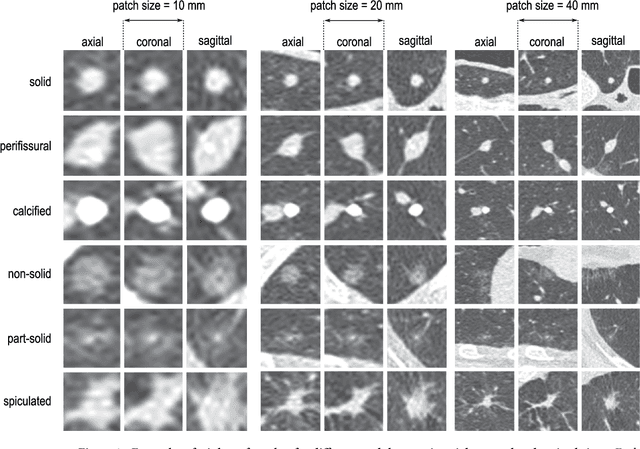 Figure 1 for Towards automatic pulmonary nodule management in lung cancer screening with deep learning