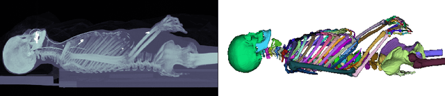 Figure 1 for 3D Segmentation Networks for Excessive Numbers of Classes: Distinct Bone Segmentation in Upper Bodies