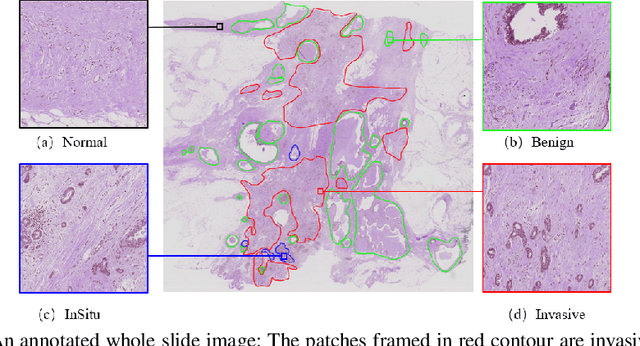 Figure 1 for A Semi-Supervised Framework for Automatic Pixel-Wise Breast Cancer Grading of Histological Images