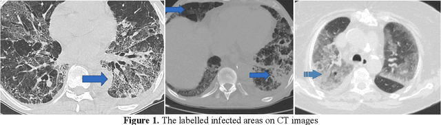 Figure 2 for Coronavirus (COVID-19) Classification using CT Images by Machine Learning Methods