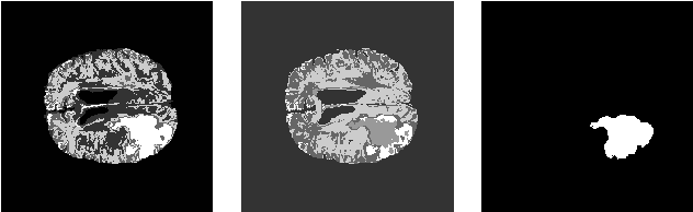 Figure 4 for Region of Interest Identification for Brain Tumors in Magnetic Resonance Images
