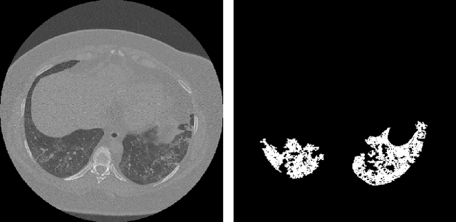 Figure 1 for CoRSAI: A System for Robust Interpretation of CT Scans of COVID-19 Patients Using Deep Learning