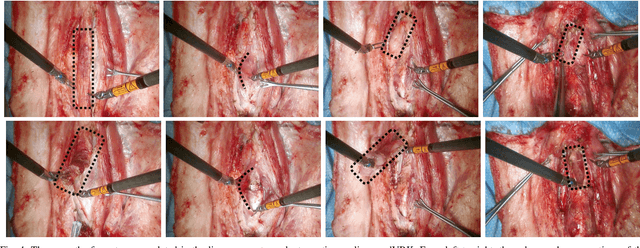 Figure 4 for From Bench to Bedside: The First Live Robotic Surgery on the dVRK to Enable Remote Telesurgery with Motion Scaling