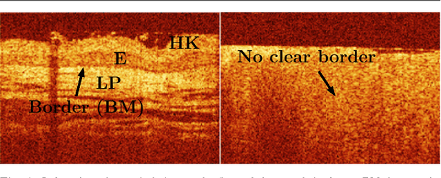 Figure 1 for Towards Automatic Lesion Classification in the Upper Aerodigestive Tract Using OCT and Deep Transfer Learning Methods