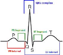 Figure 1 for Heartbeat Classification in Wearables Using Multi-layer Perceptron and Time-Frequency Joint Distribution of ECG