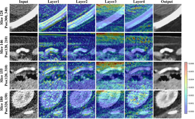 Figure 2 for CTformer: Convolution-free Token2Token Dilated Vision Transformer for Low-dose CT Denoising