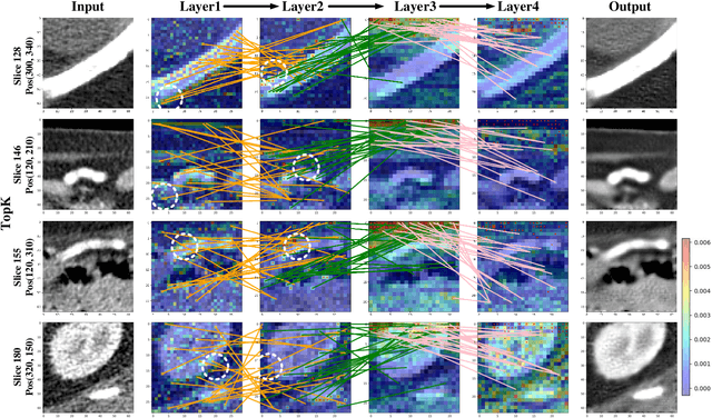 Figure 3 for CTformer: Convolution-free Token2Token Dilated Vision Transformer for Low-dose CT Denoising