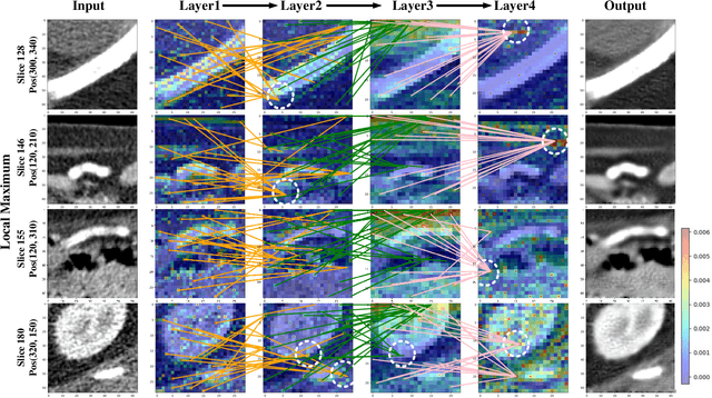 Figure 4 for CTformer: Convolution-free Token2Token Dilated Vision Transformer for Low-dose CT Denoising