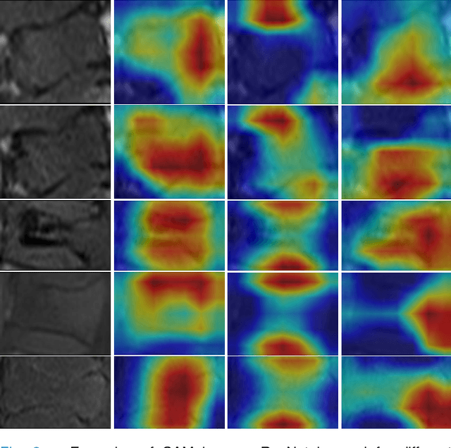 Figure 3 for Two-Stream Compare and Contrast Network for Vertebral Compression Fracture Diagnosis