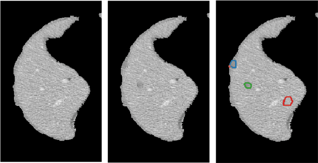 Figure 4 for Decoupling Shape and Density for Liver Lesion Synthesis Using Conditional Generative Adversarial Networks