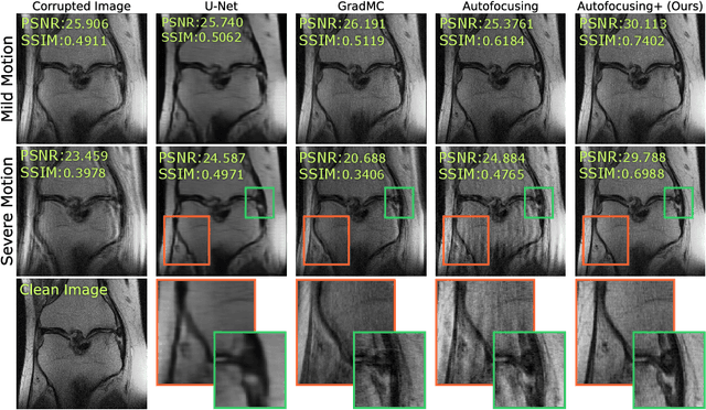 Figure 3 for Autofocusing+: Noise-Resilient Motion Correction in Magnetic Resonance Imaging