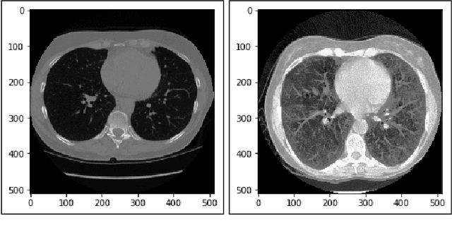 Figure 2 for Lung Cancer Detection and Classification based on Image Processing and Statistical Learning
