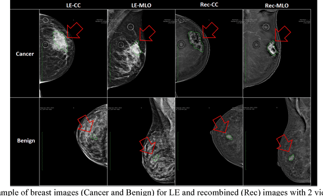 Figure 1 for SD-CNN: a Shallow-Deep CNN for Improved Breast Cancer Diagnosis