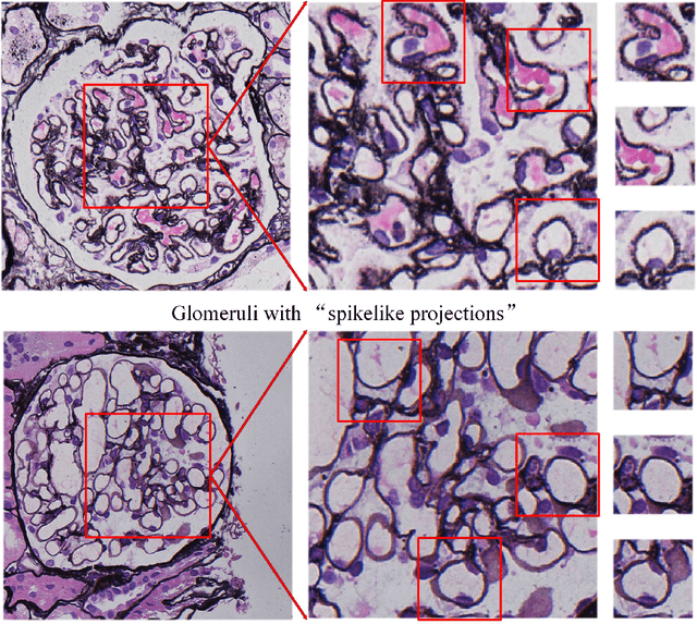 Figure 1 for MSA-MIL: A deep residual multiple instance learning model based on multi-scale annotation for classification and visualization of glomerular spikes