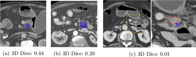 Figure 4 for Improved Pancreatic Tumor Detection by Utilizing Clinically-Relevant Secondary Features