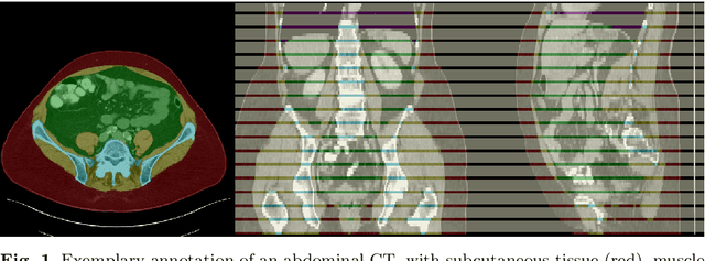 Figure 1 for Fully-automated Body Composition Analysis in Routine CT Imaging Using 3D Semantic Segmentation Convolutional Neural Networks