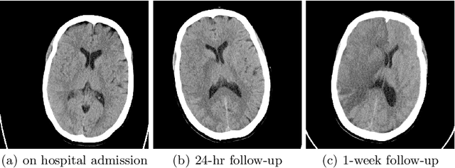 Figure 1 for Prediction of Thrombectomy Functional Outcomes using Multimodal Data